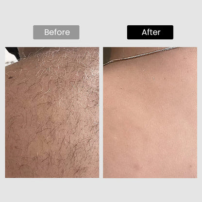 V8S Diode Laser Hair Removal, 810Nm, Faster Results, Most Powerful