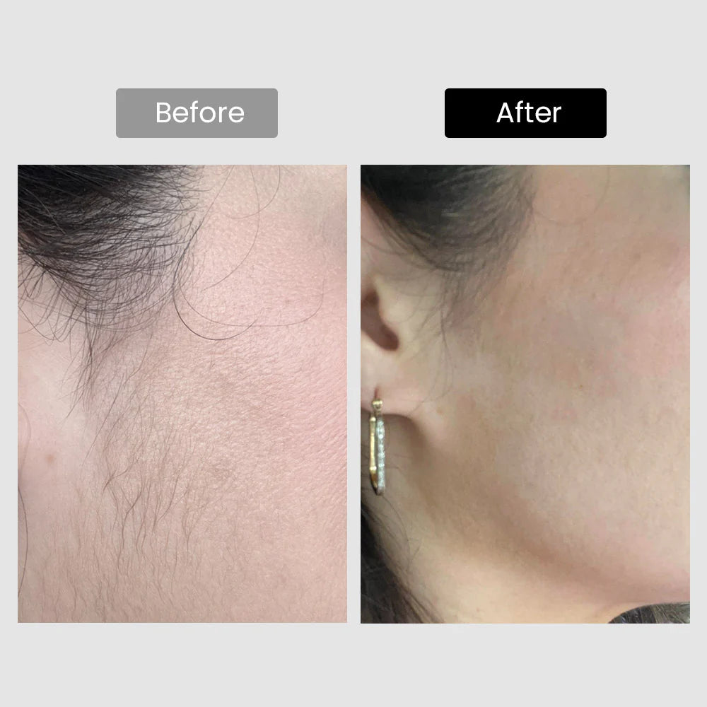 V8S Diode Laser Hair Removal, 810Nm, Faster Results, Most Powerful